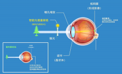 哺光仪对近视的预防控制作用