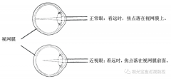 什么是近视？近视征状,近视形成,预防方法